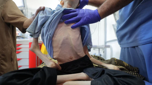 5 die of malnutrition in Gaza in past 24 hours, health officials say